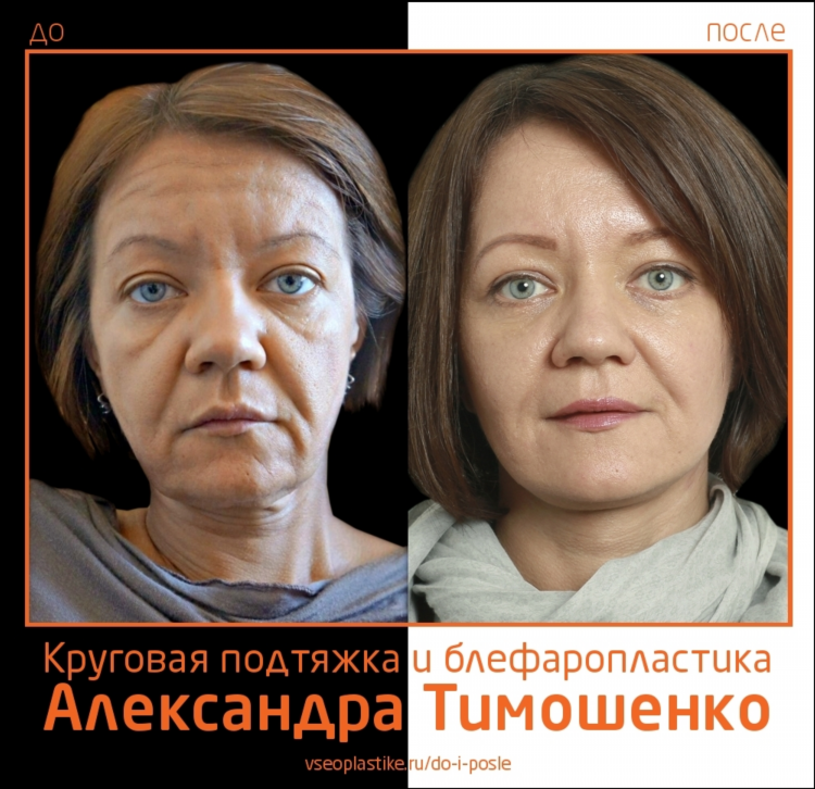 Подтяжка лица в калининграде